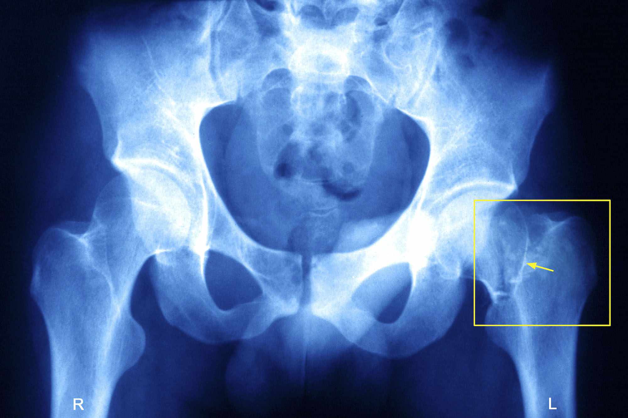 What are the symptoms of a hairline fracture in the hip?