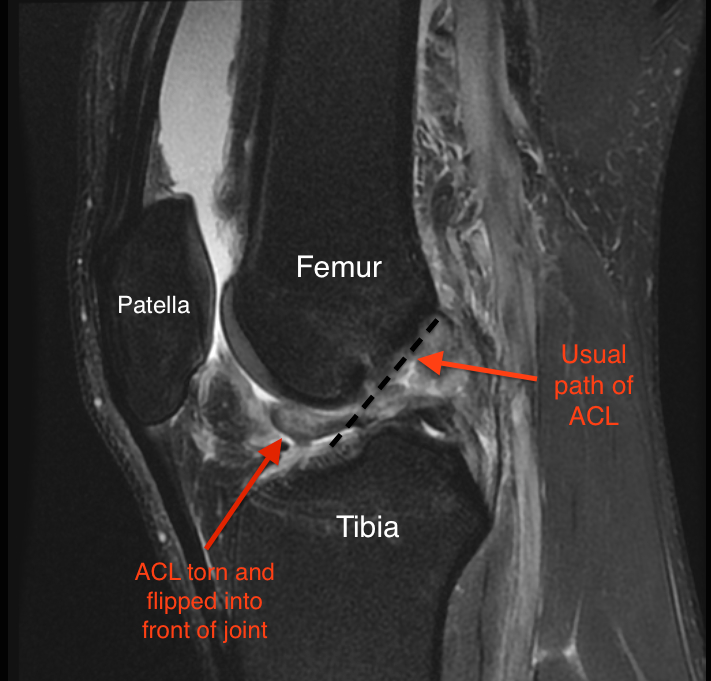 What is ACL tear ICD 11?