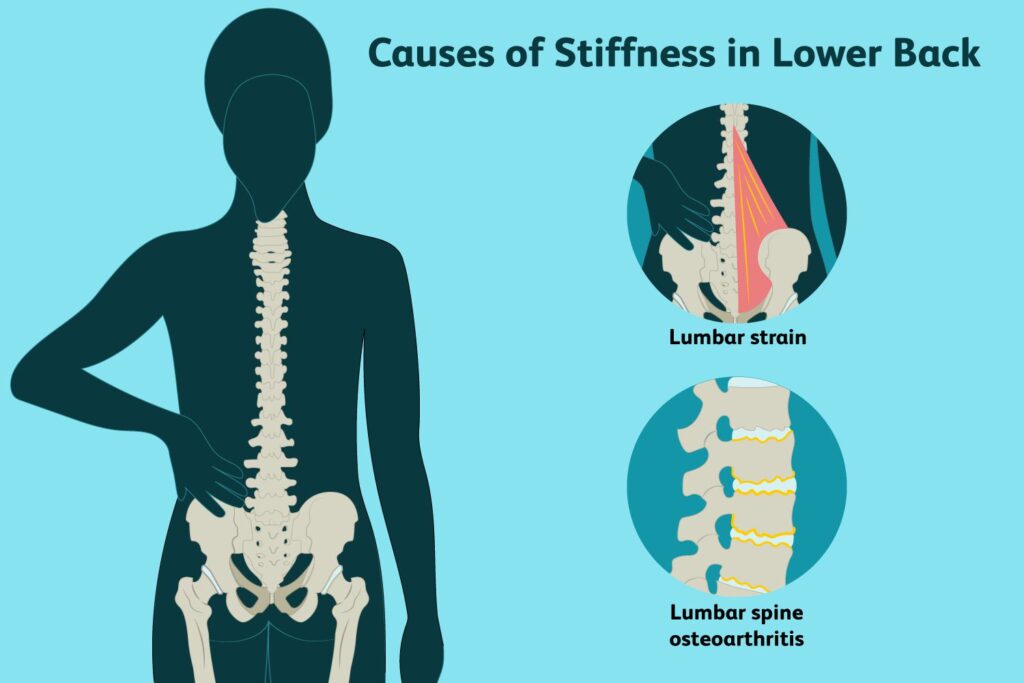 What are the symptoms of a stiff back?