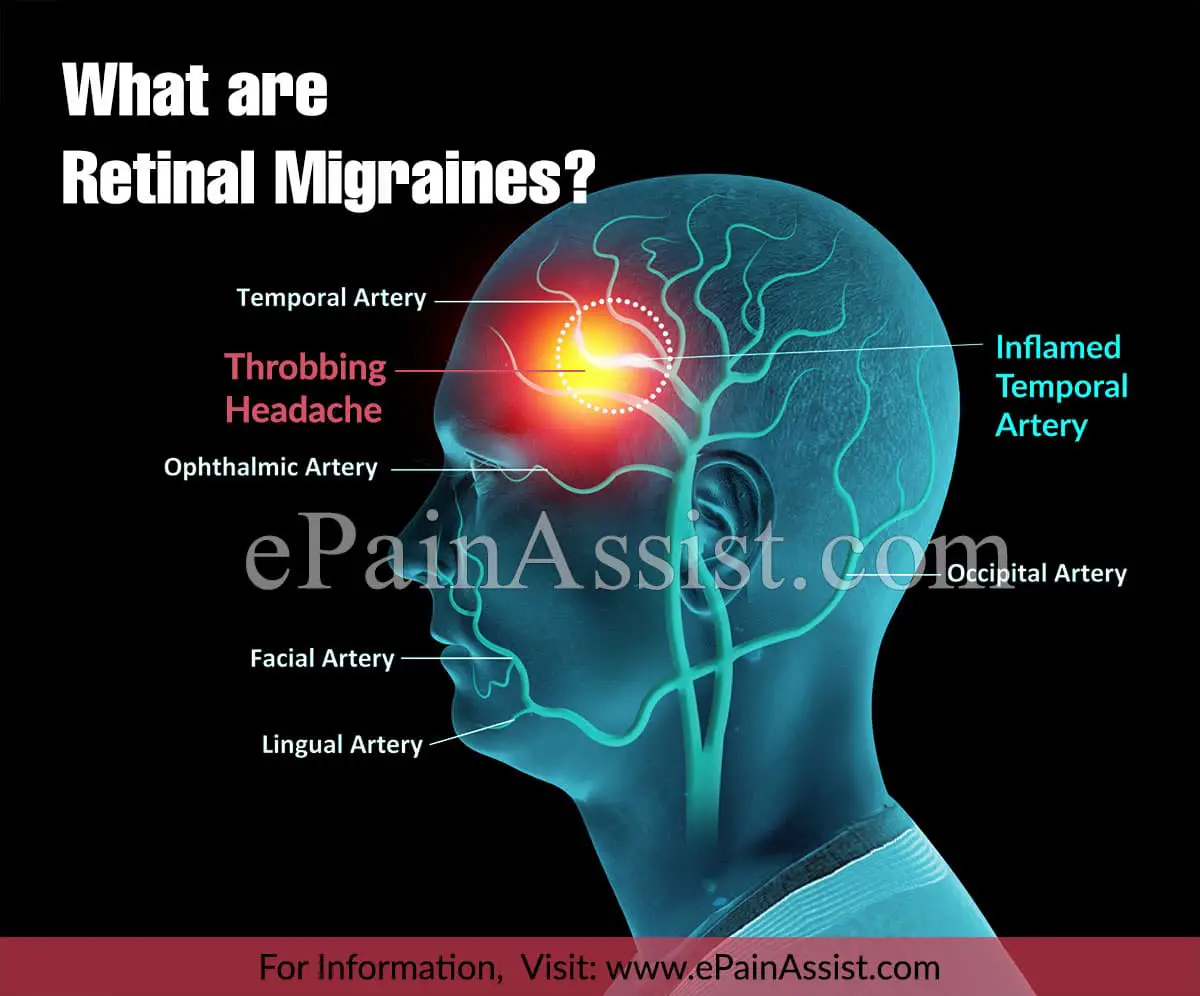 What is the difference between an ocular migraine and a retinal migraine?