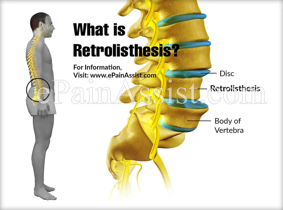 What is the best treatment for retrolisthesis?