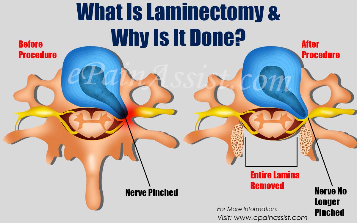 What happens if you twist after a laminectomy?