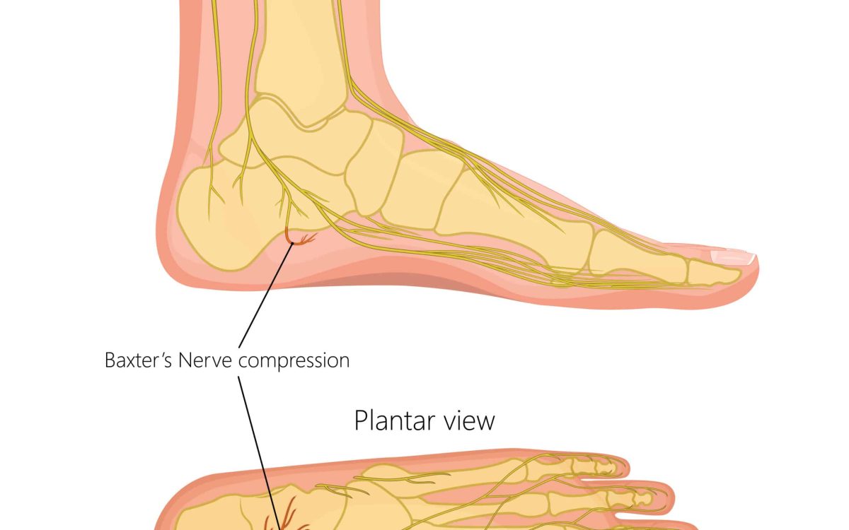 Can you live a normal life with Morton’s neuroma?