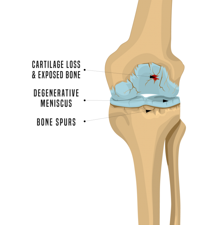 Can knee arthritis pain radiate down the leg?